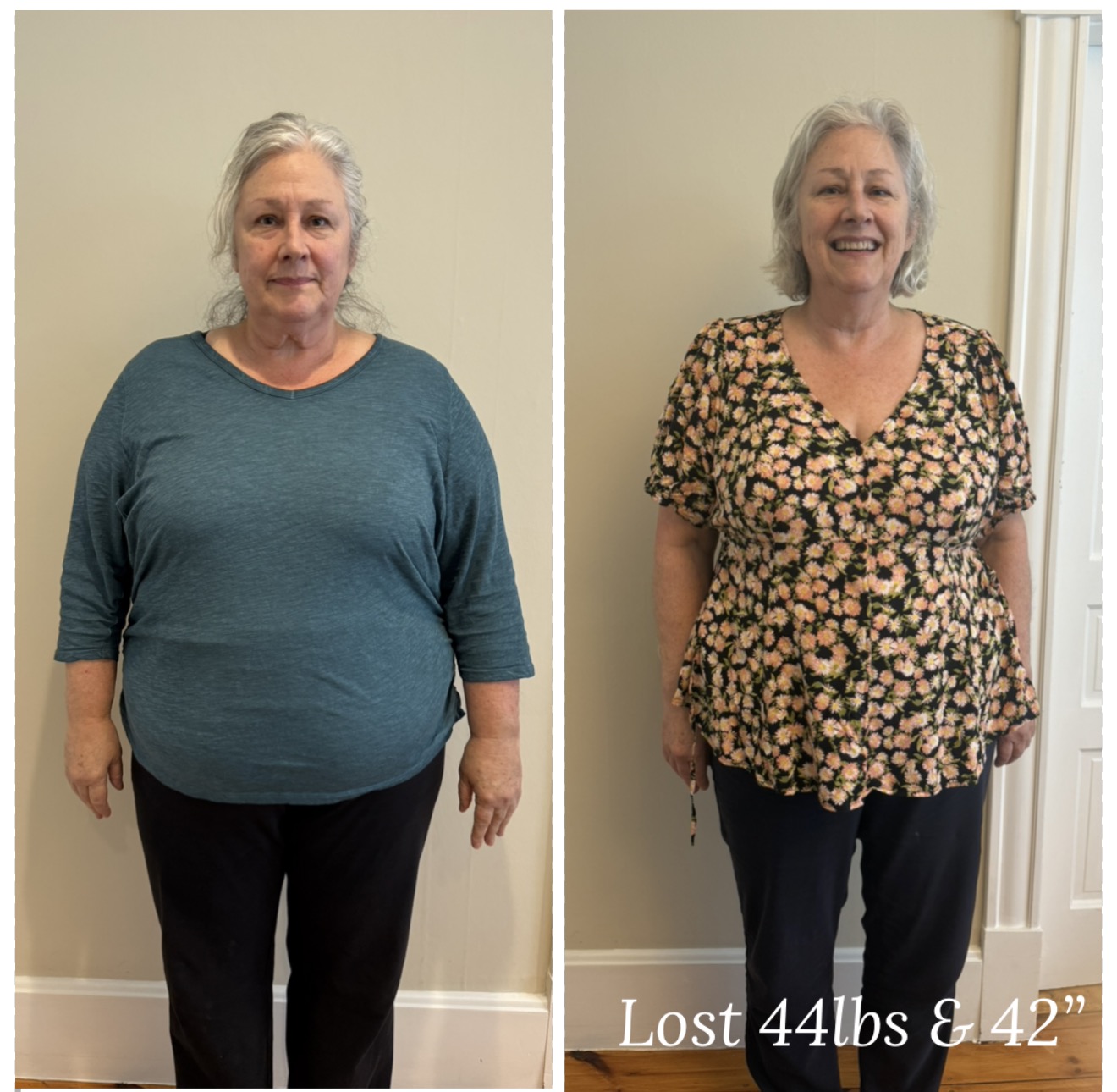 Before and after photos of Linda T., who lost 37 lbs and 52 inches combining ChiroThin and GLP programs